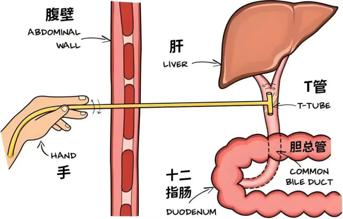 胆总管t型管拔管图图片