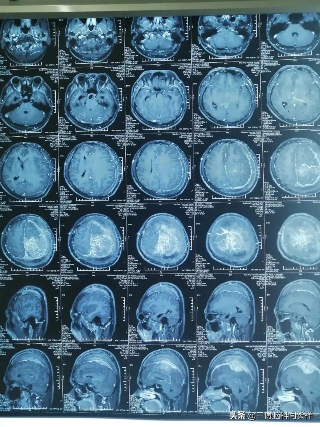 变形的头顶_脑膜瘤_相关疾病_就诊指导_症状表现 - 好大夫在线