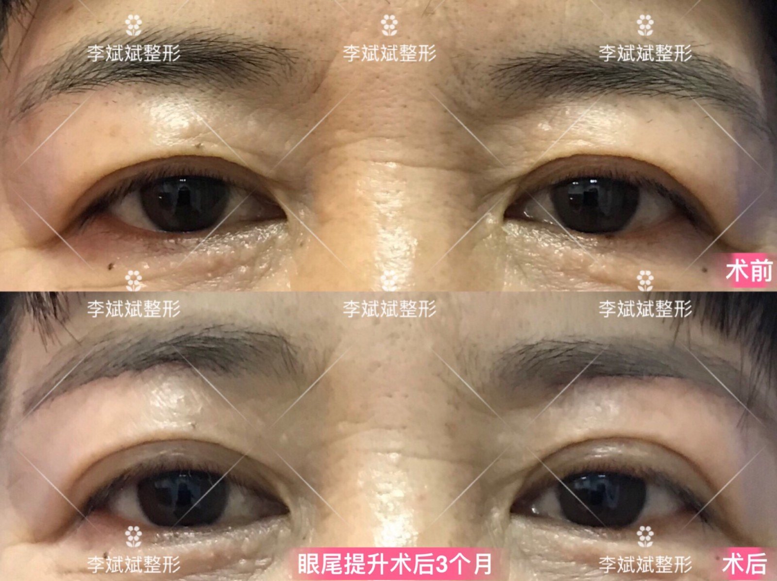 李斌斌手术实例——外眼角提升术详解及案例:外眼角提升适合哪些人