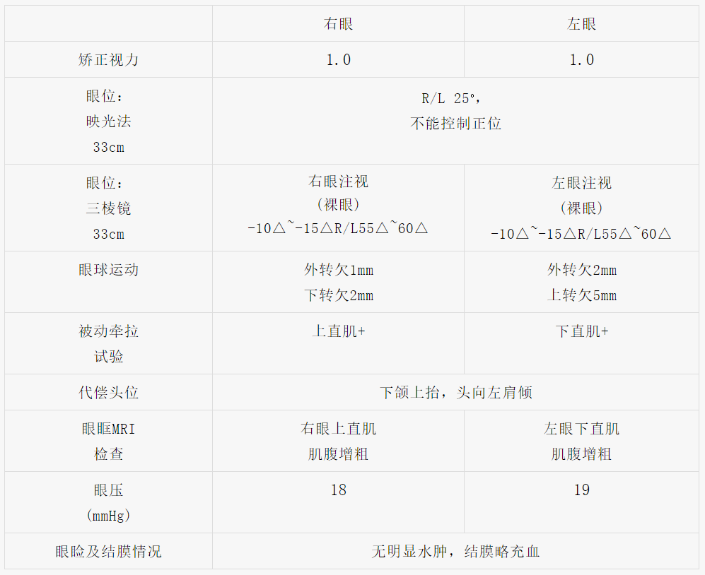graves眼病系列病例⑦——斜视矫正术_graves眼病_graves眼病治疗方式