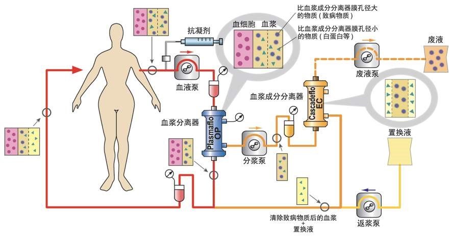 揭秘系列之六洗血疗法血浆置换免疫吸附