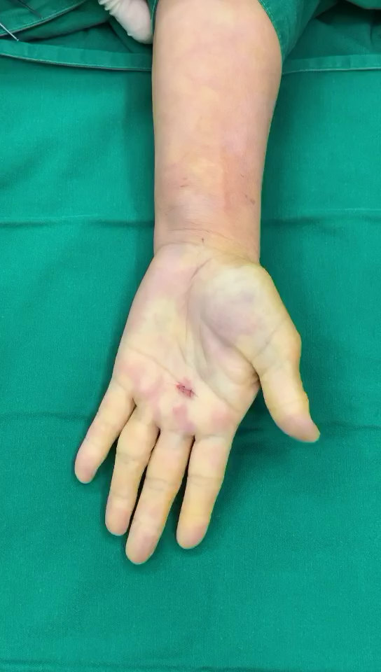 腱鞘炎:弹响指(中指),治疗后即刻效果改善显著