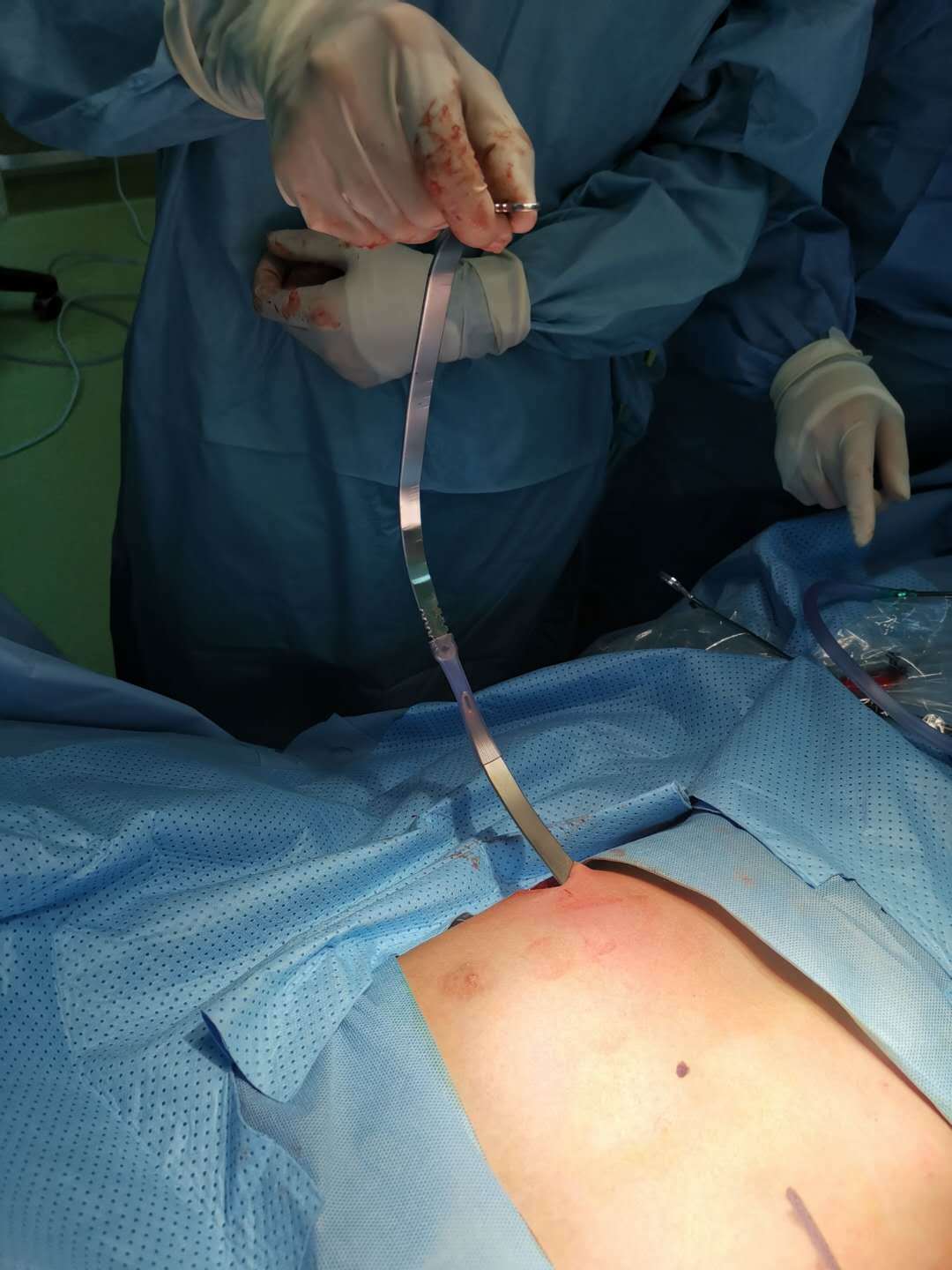 漏斗胸照片 手术图片