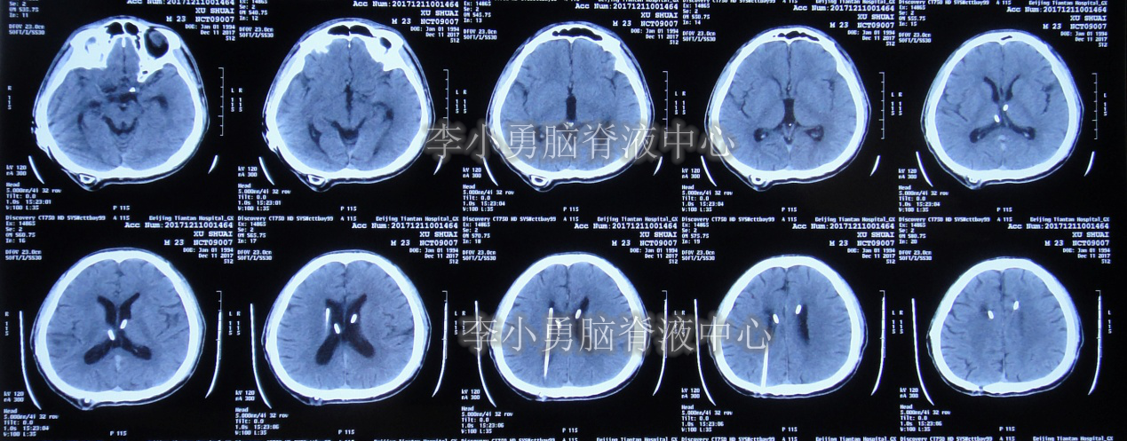 男子腦畸胎瘤術後腦積水18年內3次腦室腹腔分流術和3次調整分流泵壓後