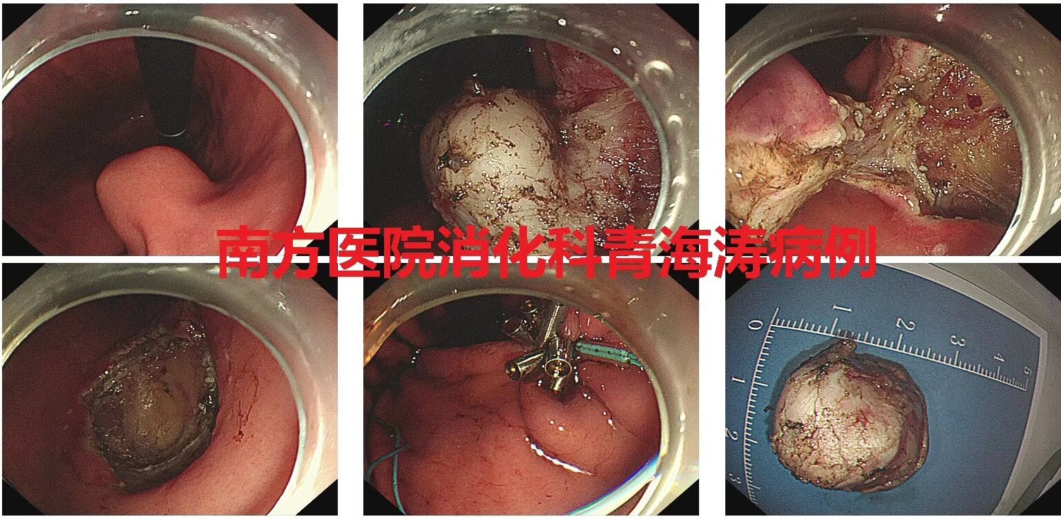 青海涛教授完成直肠多发神经内分泌肿瘤?