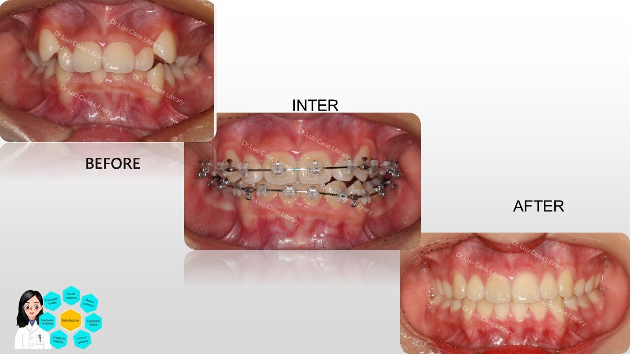 矫正方案:拔除上4下5,同时使用forsus导下颌向前.