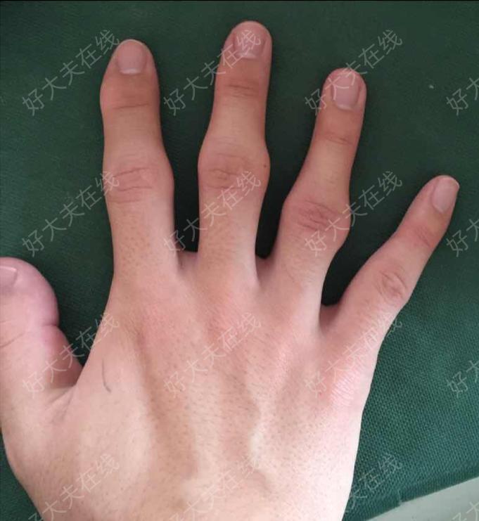 患者多个手指近侧指间关节粗大,影响外观,无明显活动受限