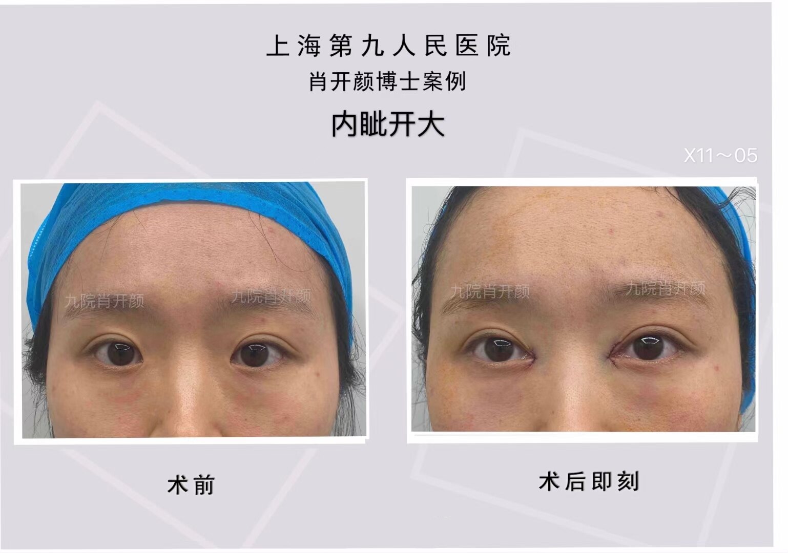 内眦开大 - 好大夫在线