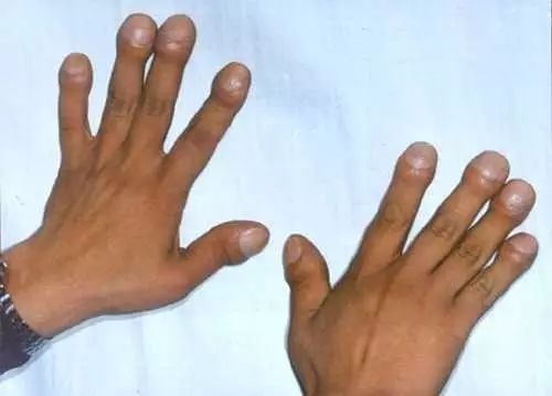 容貌突然变丑手脚变粗大很可能和垂体瘤有关