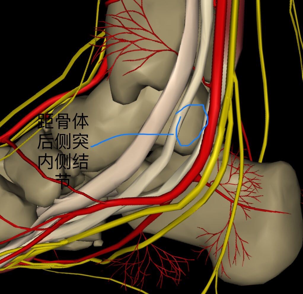 距骨体后突内侧结节骨软骨瘤精准施术一例报告