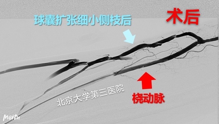 透析用的动静脉内瘘堵了,怎么办_肾功能衰竭_肾功能衰竭治疗方式 - 好