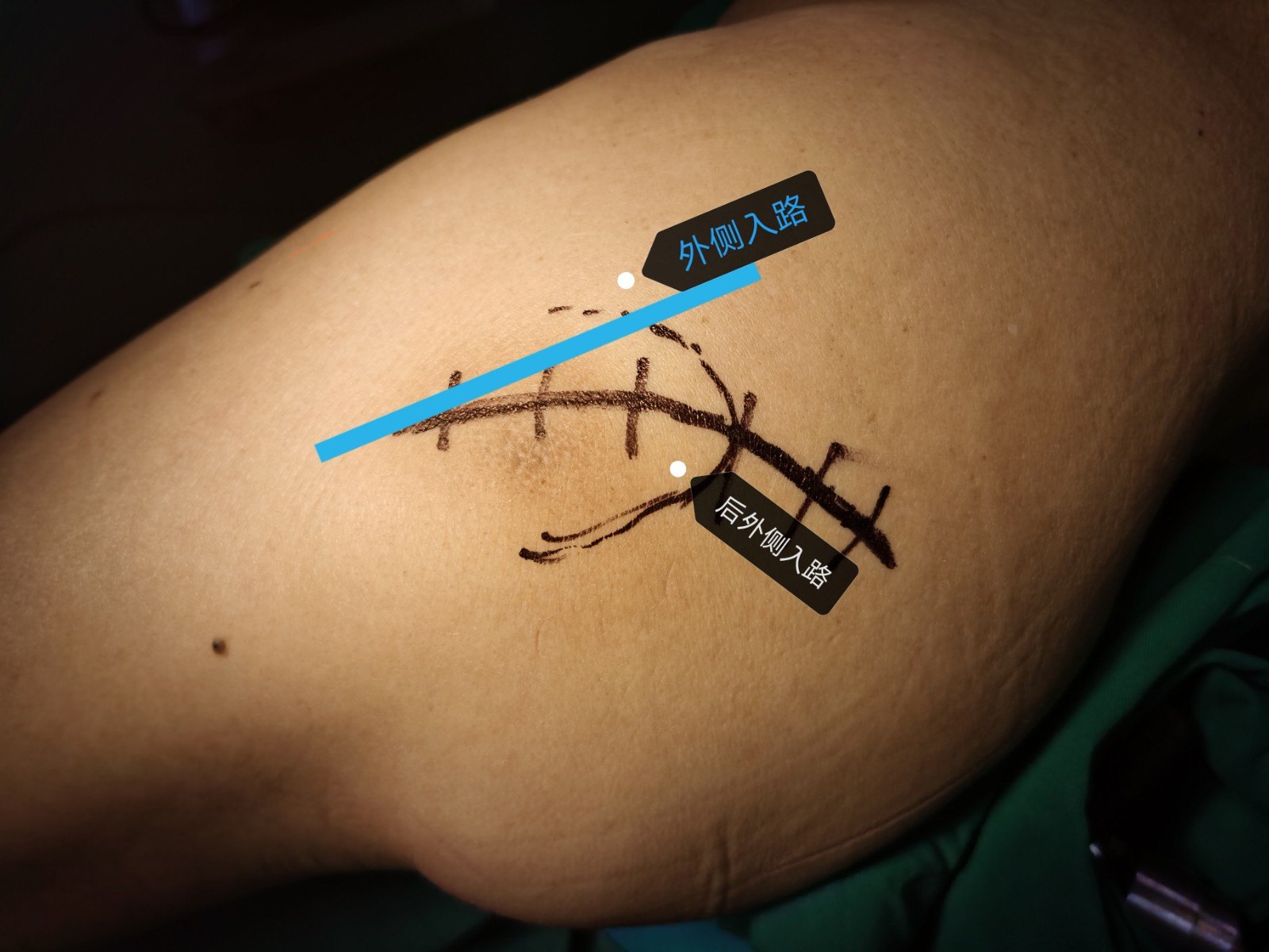 害怕髋关节手术疤痕影响美观现在这些都不是事儿了比基尼切口髋关节