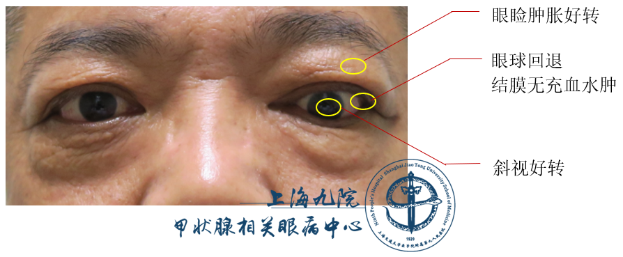 眼球脂肪脱垂图片图片