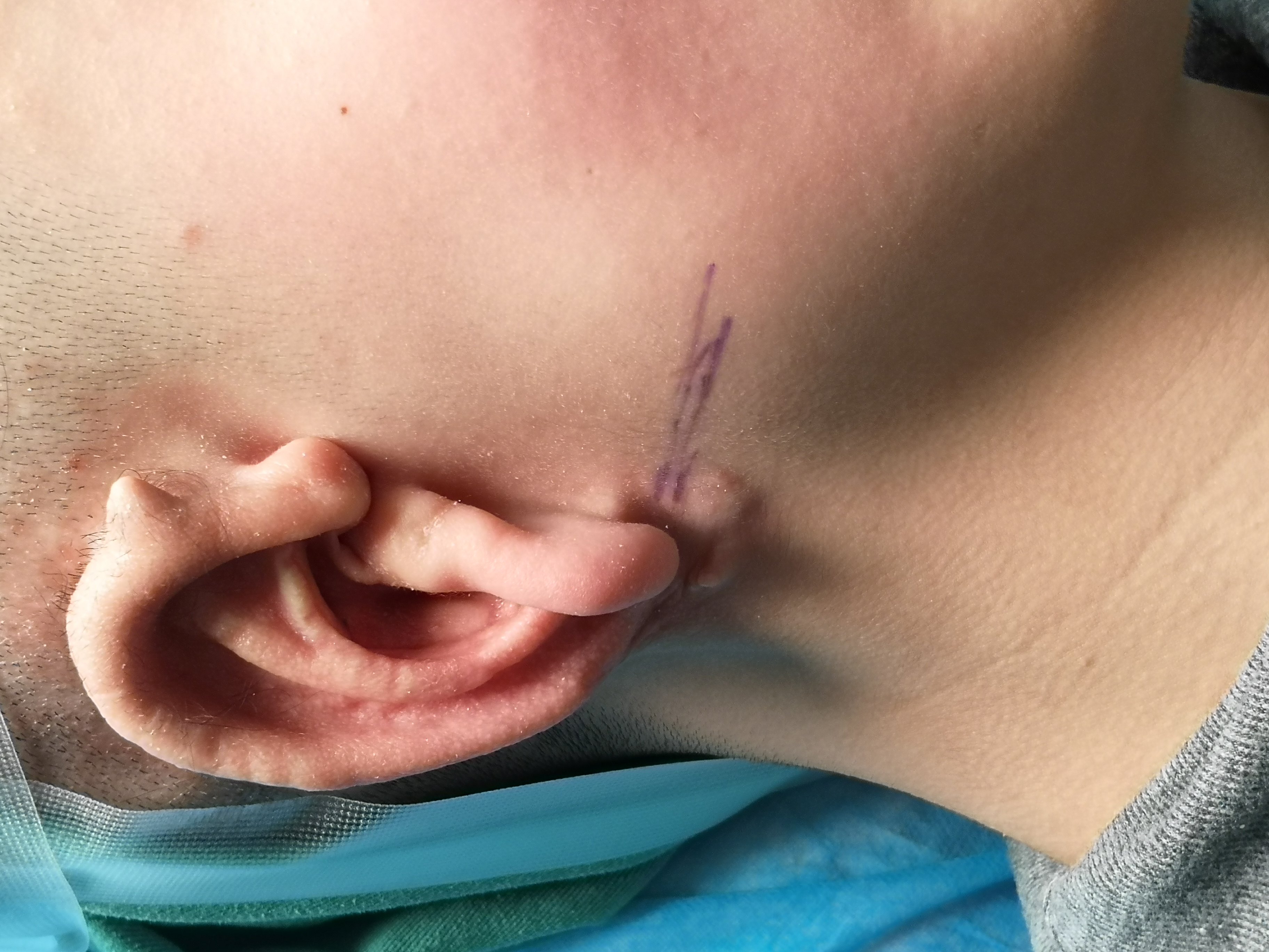 新生儿耳廓畸形