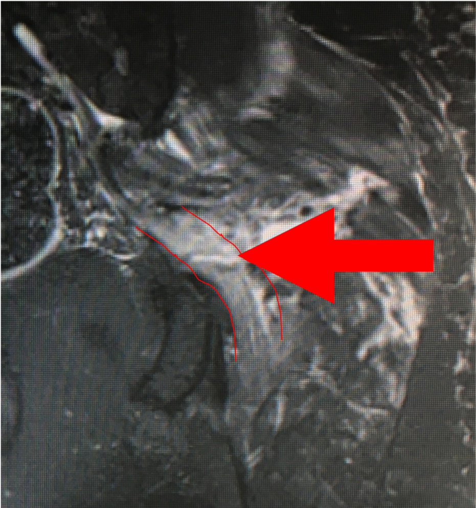 坐骨神经损伤_坐骨神经损伤治疗方式 - 好大夫在线