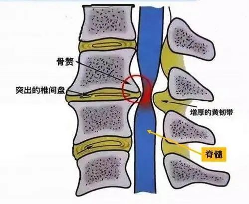 得了脊髓型颈椎病要注意 这类颈椎病要尽早治疗 脊髓型颈椎病 得了脊髓型颈椎病要注意 这类颈椎病要尽早治疗 脊髓型颈椎病