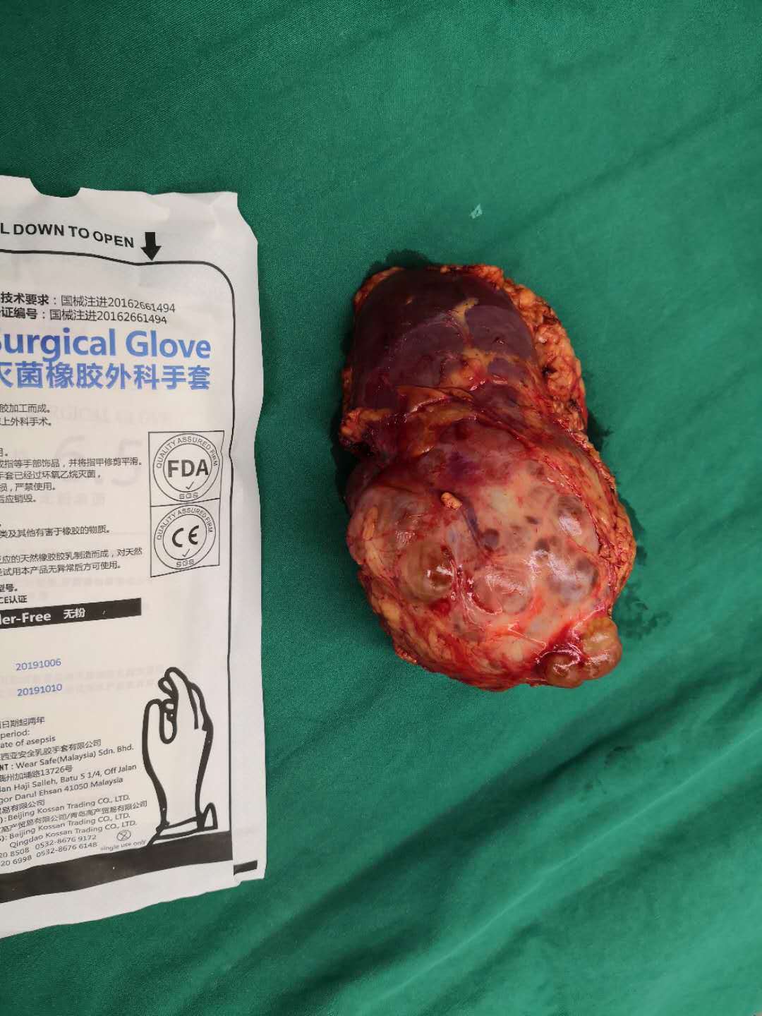 典型病例低度惡性潛能的多房囊性腎腫瘤舊稱為囊性腎癌