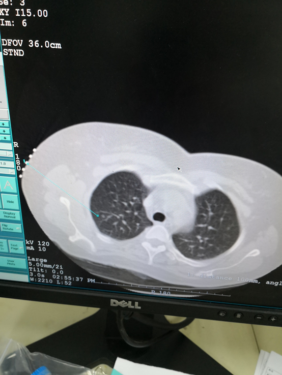 肺结节故事一:一个焦虑症患者磨玻璃微小结节的手术前后经过 - 好大夫