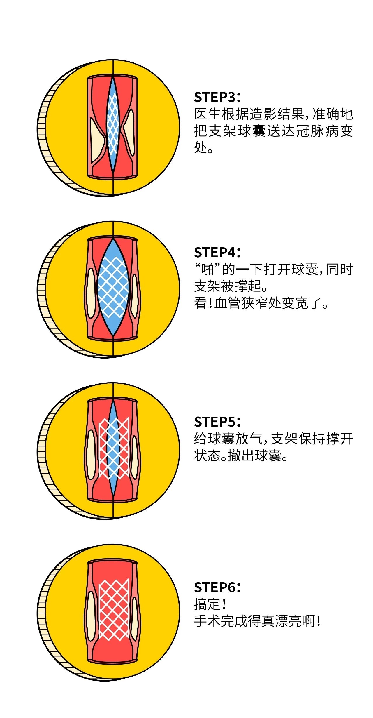 漫画图解心脏支架是怎么装进去的