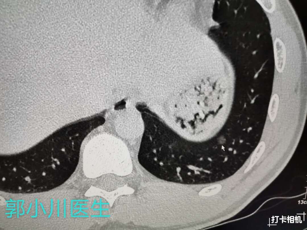 肺结节图片2.jpg