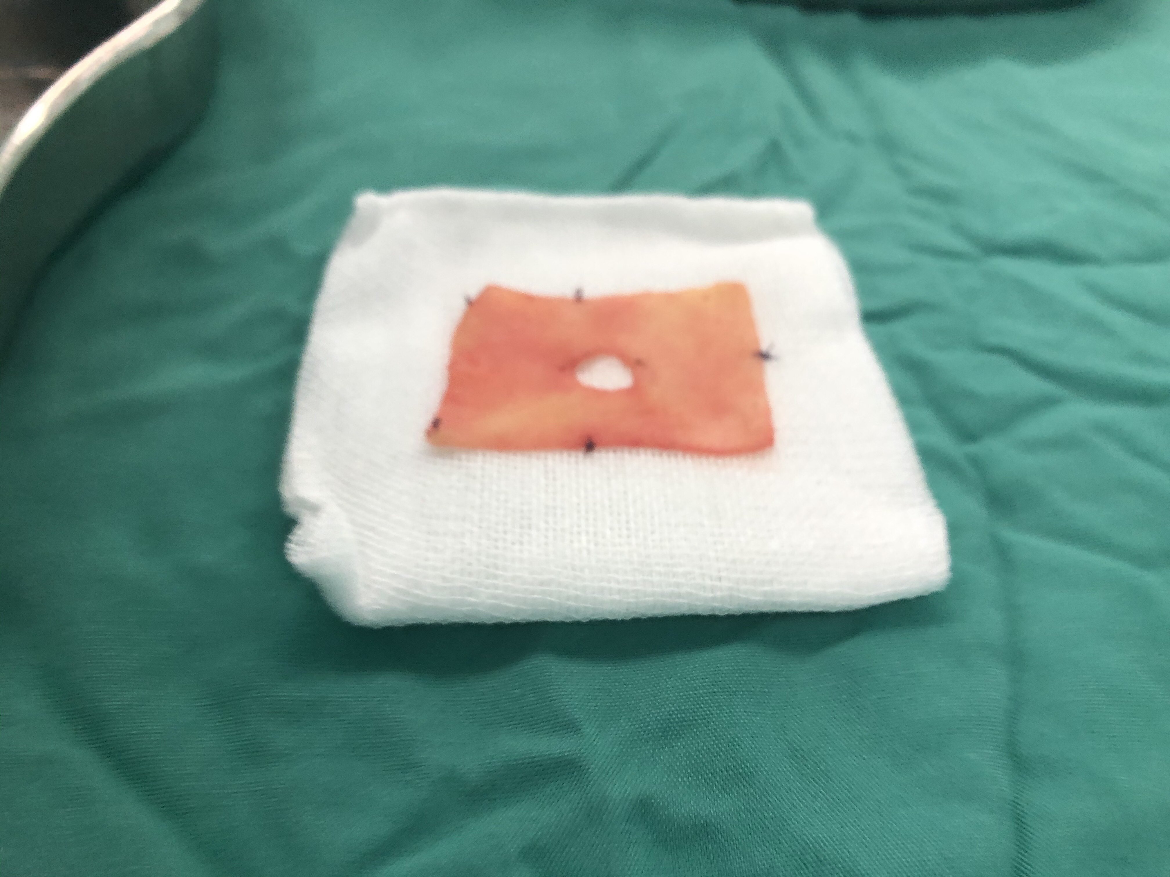 我院泌尿外科成功实施局麻下阴茎人工海绵体植入手术 - 知乎