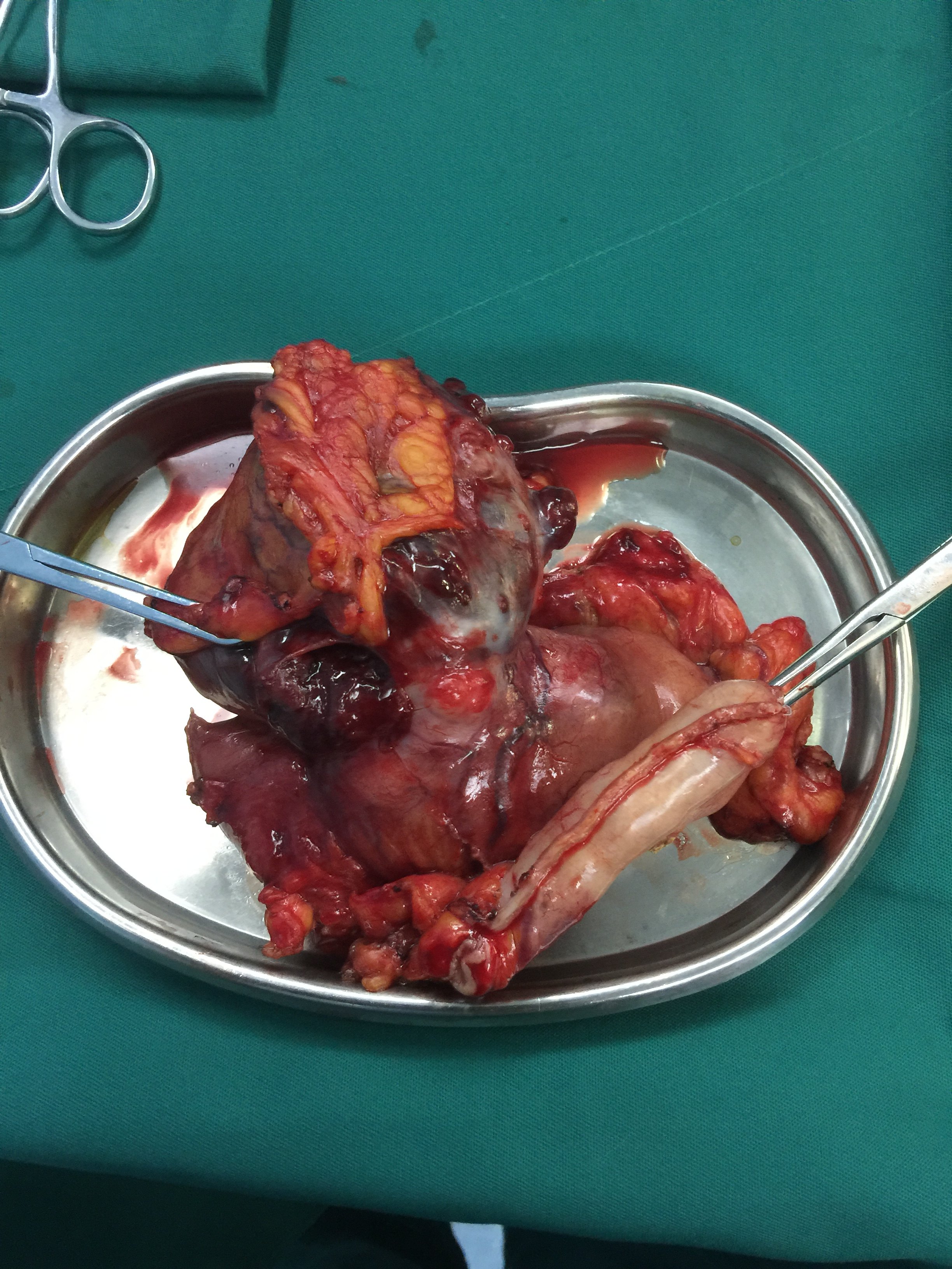 胃肿瘤手踔瘟 - 好大夫在线