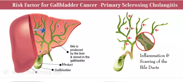 体检发现胆囊息肉怎么办