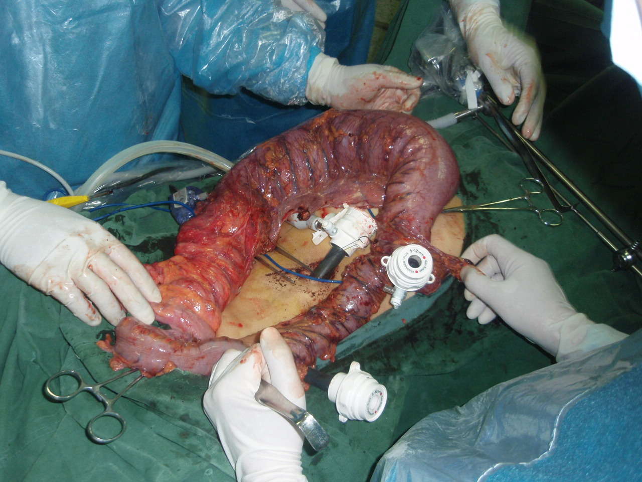 切口拆线时的情况——小切口减少了传统开放手术对腹壁的破坏和对外观