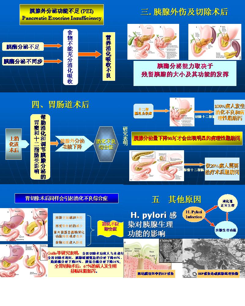 胰腺外分泌功能不全的诊治