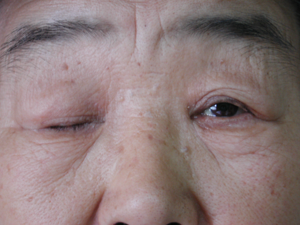 重症肌无力克星—微创胸腺切除 - 好大夫在线