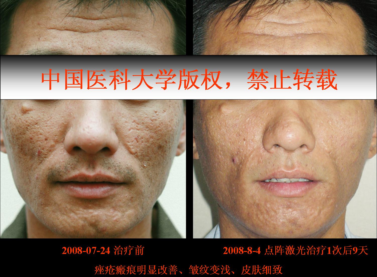 点阵激光联合强脉冲光治疗炎症性痤疮,痤疮瘢痕的临床经验 - 好大夫