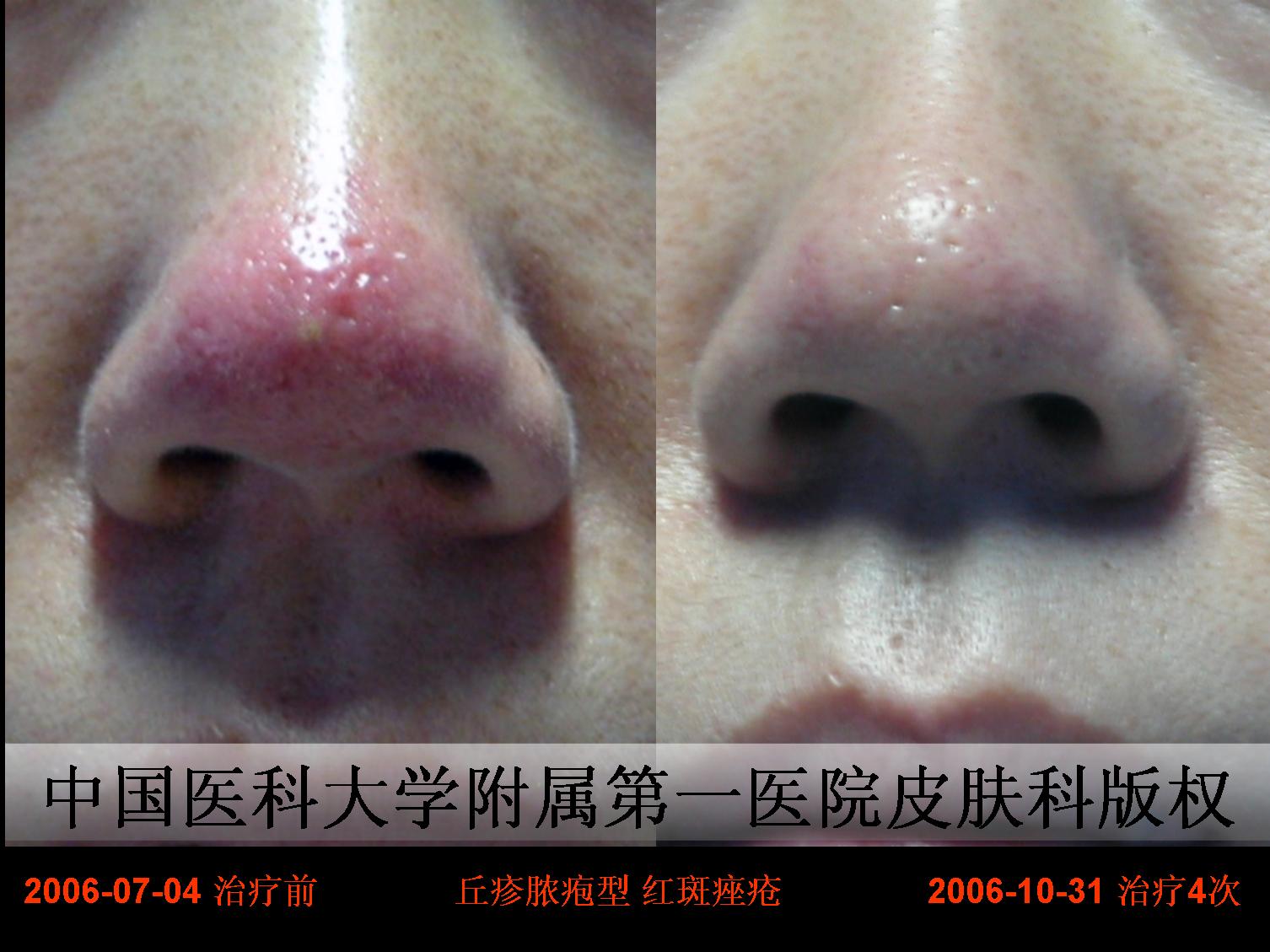 红斑痤疮酒渣鼻的综合治疗