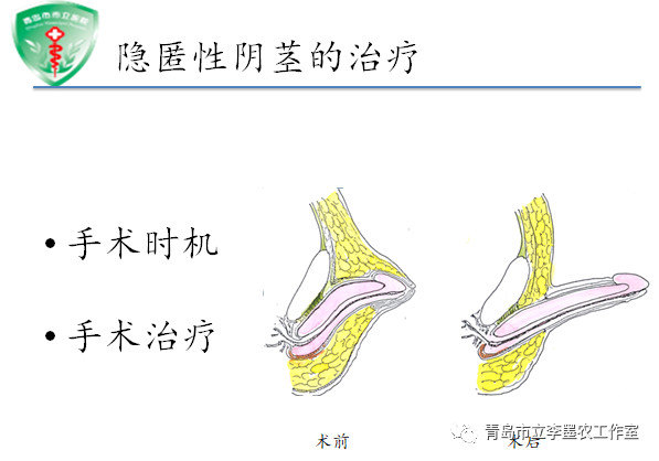 隐匿阴茎治疗和进展