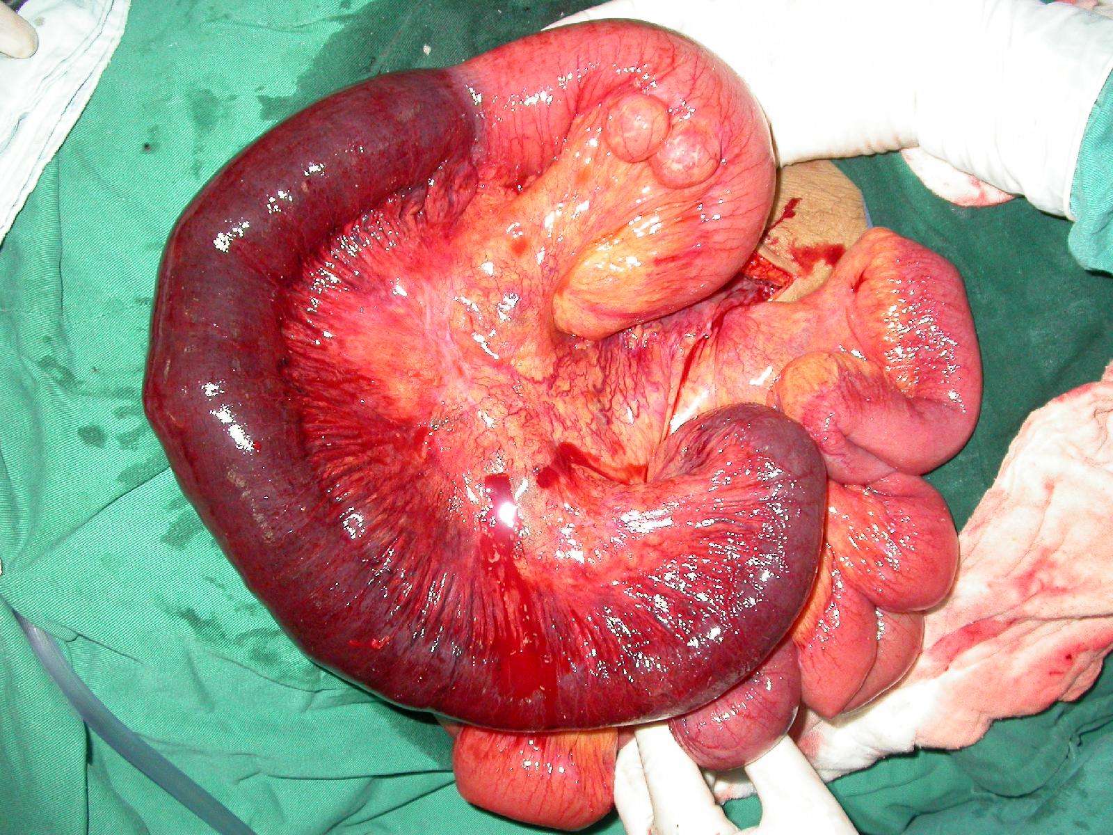 早期确定性手术治疗肠系膜上静脉血栓形成 - 好大夫在线