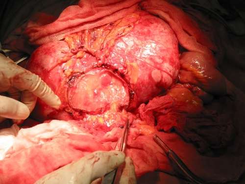 我切除的1例腹膜后硬纤维瘤第3次复发照片 - 好大夫在线