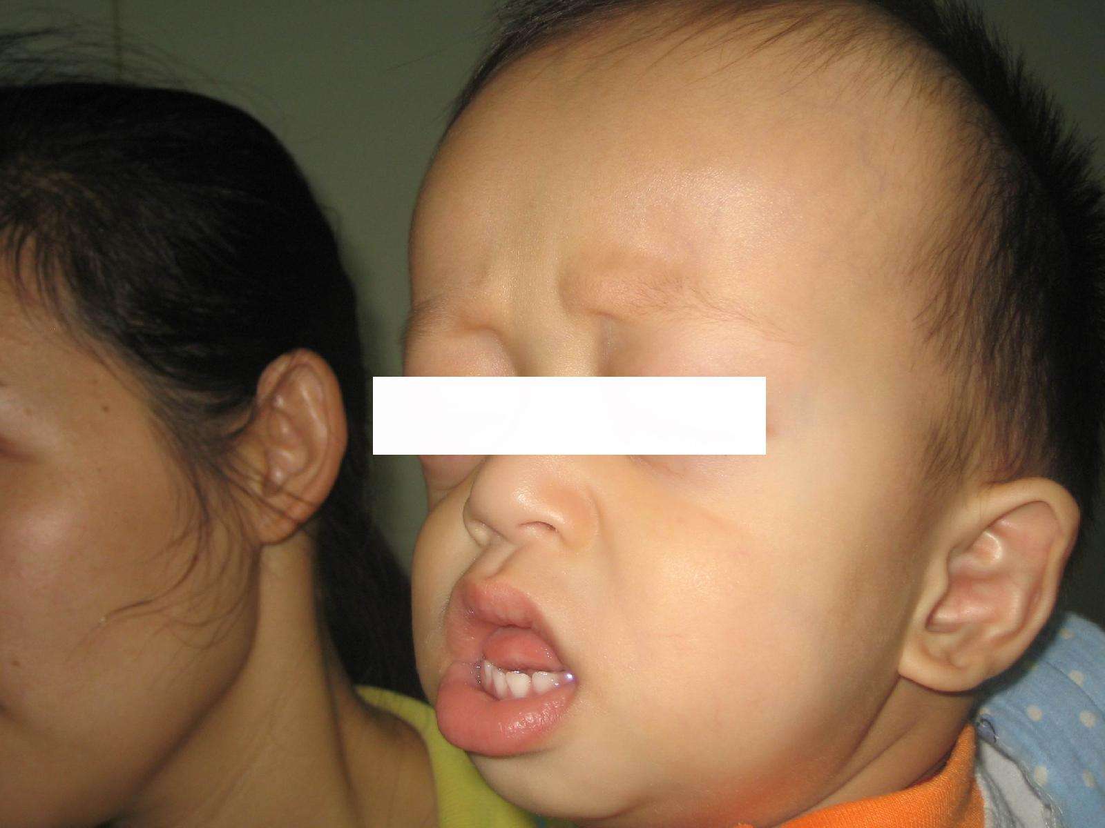 treacher collins综合征是一种复杂的先天性颅面畸形,属常染色体显性