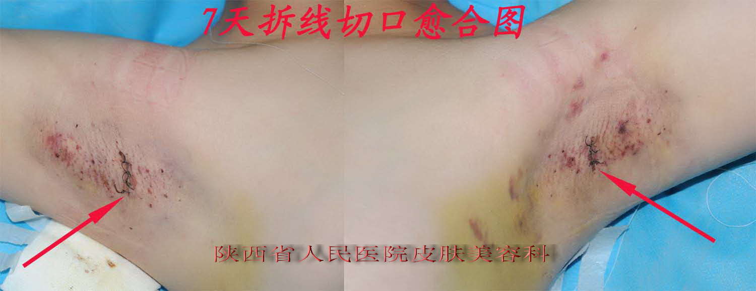 腋臭手术恢复过程图片图片