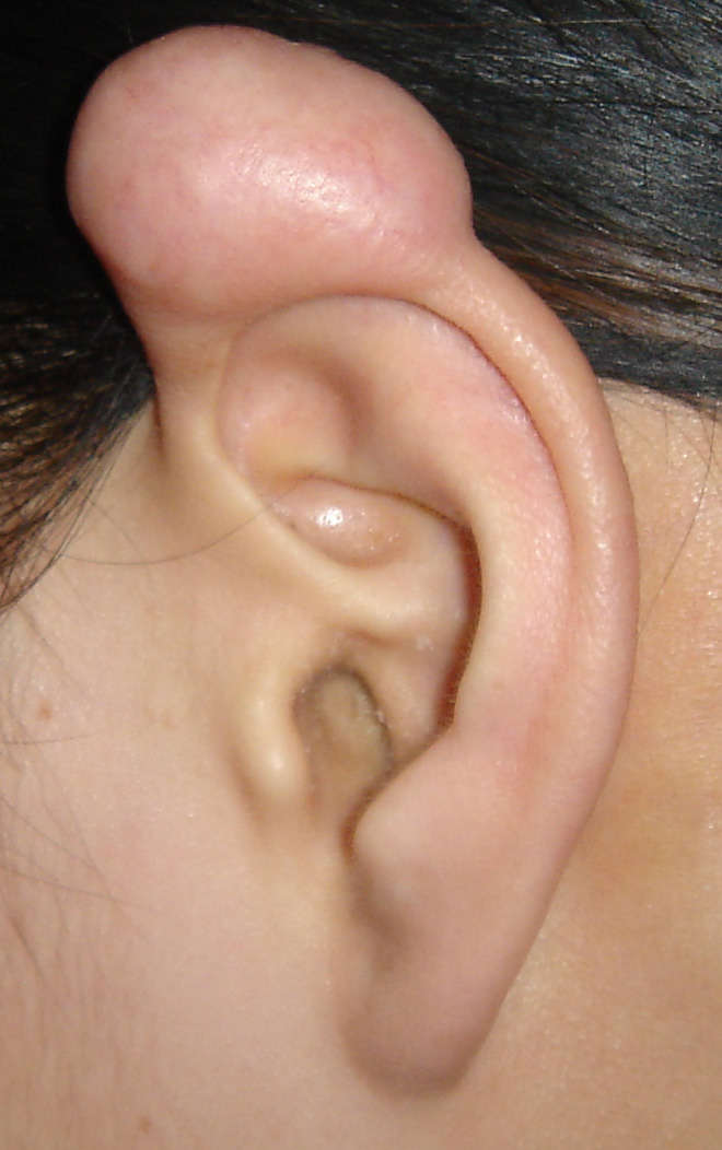 耳廓瘢痕疙瘩的治疗