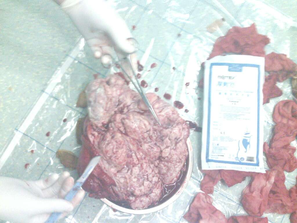 7.腹腔镜子宫次切术,顺利.—2012.9.256.tcrf,顺利.5.