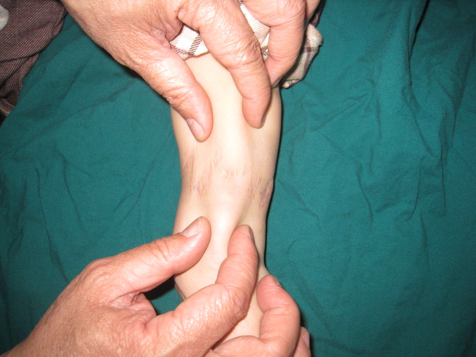 先天性束带综合症的治疗