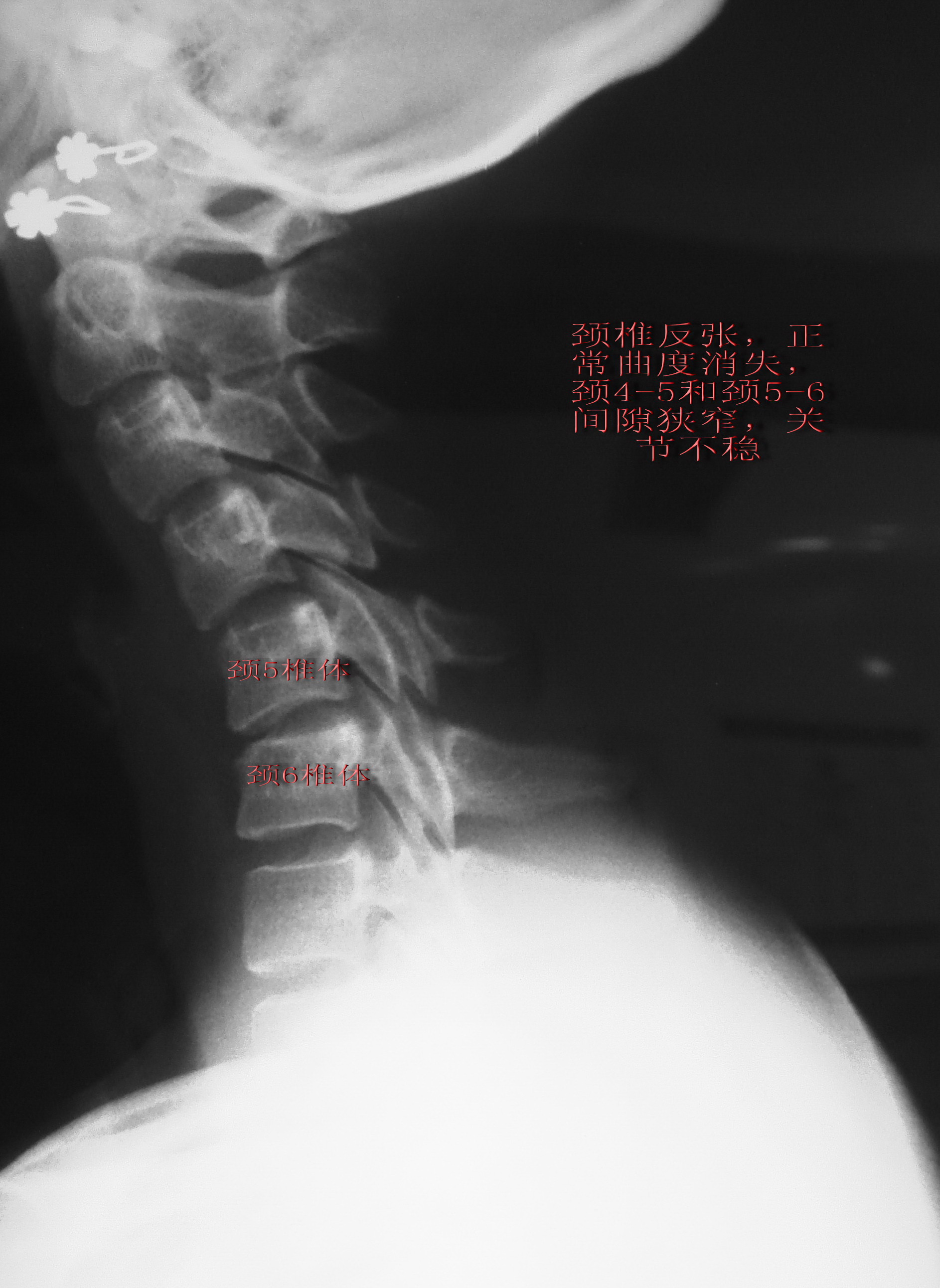 颈椎突出是什么样子的图片