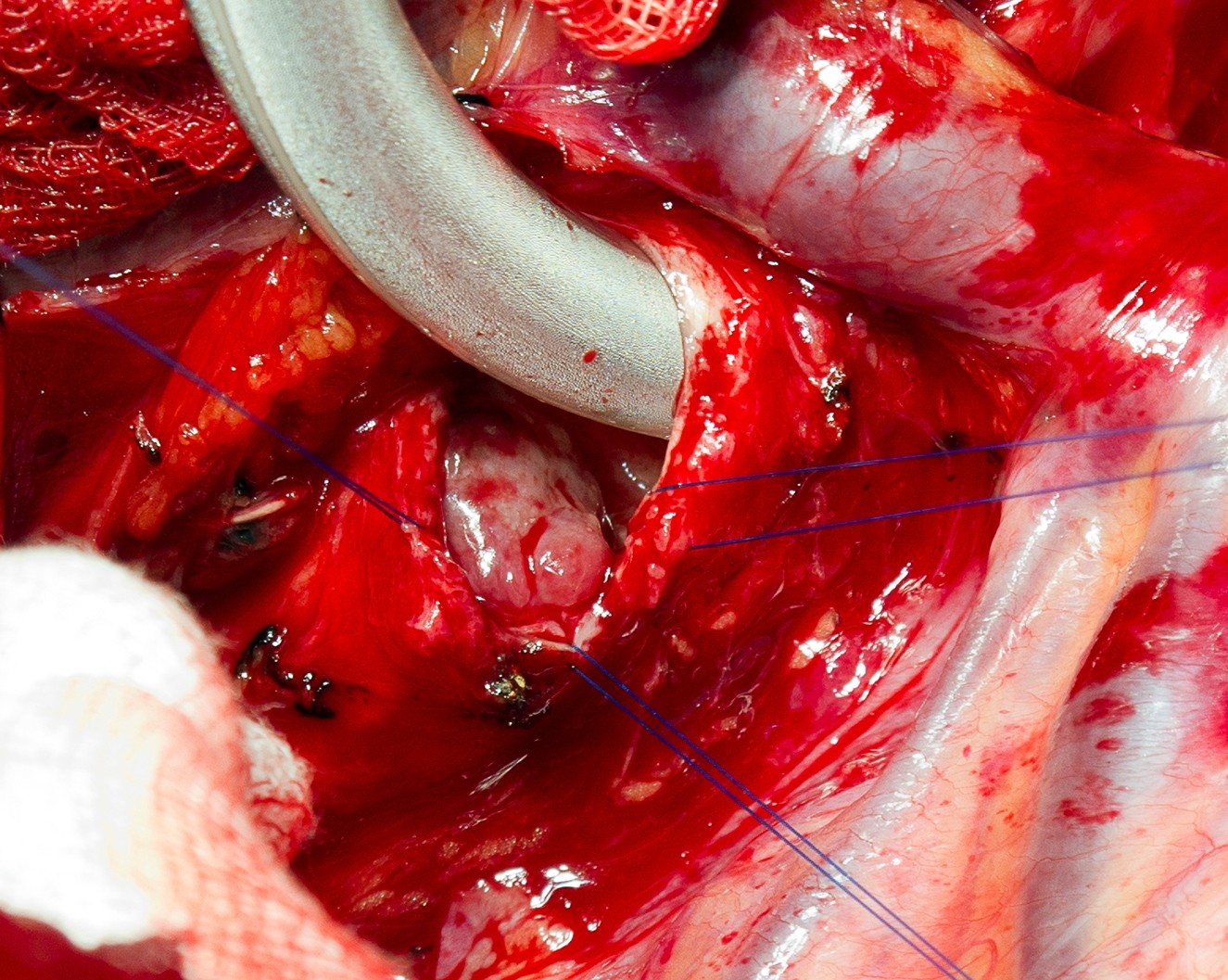 宁波二院成功实施首例体外循环下气管肿瘤切除术 - 好大夫在线