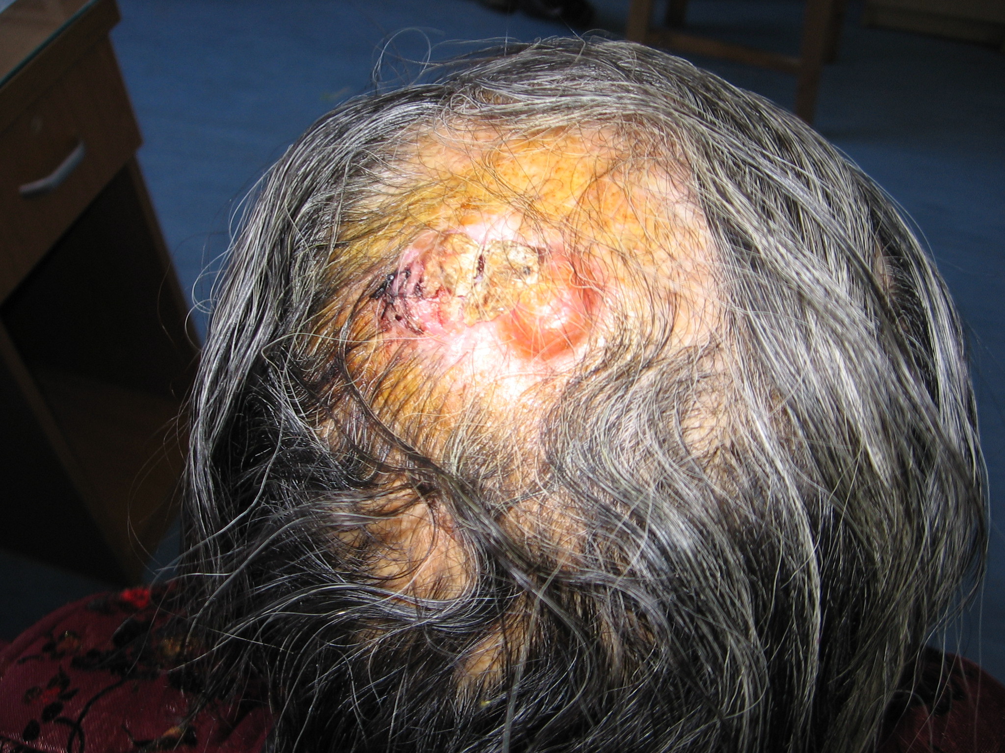 头皮鳞状细胞癌图片图片