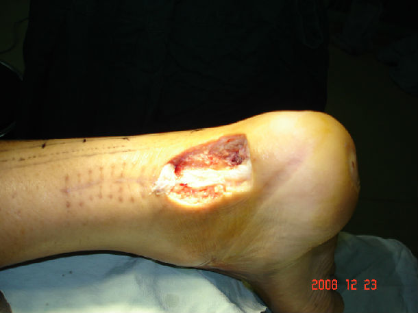 跟腱外伤术后外露皮瓣修复术