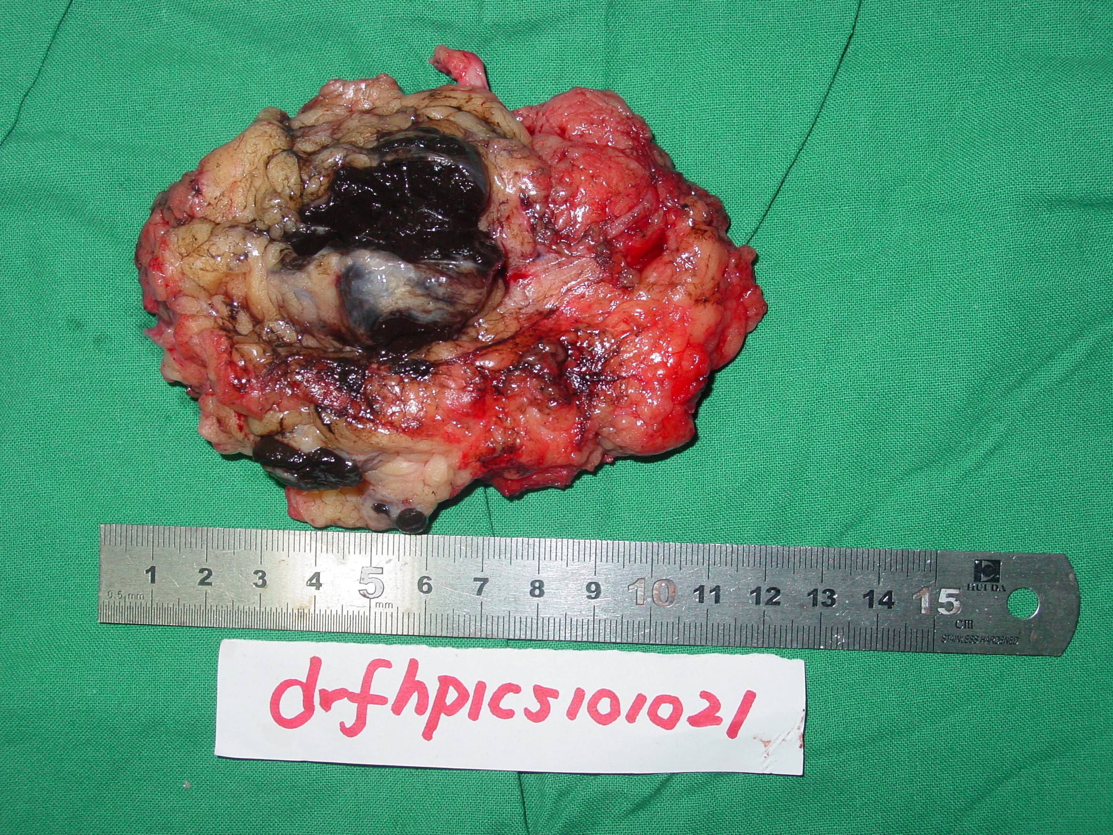大腿腹股沟淋巴瘤图片图片