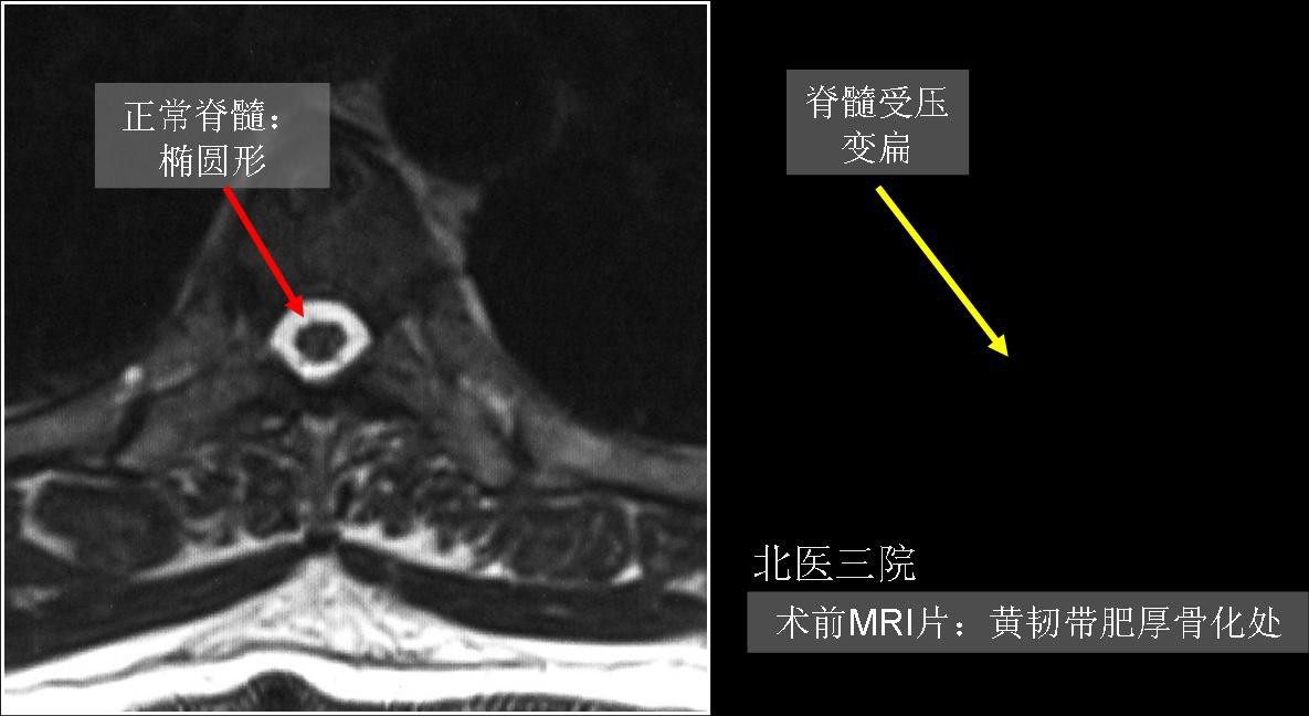 床突间韧带钙化影像图图片