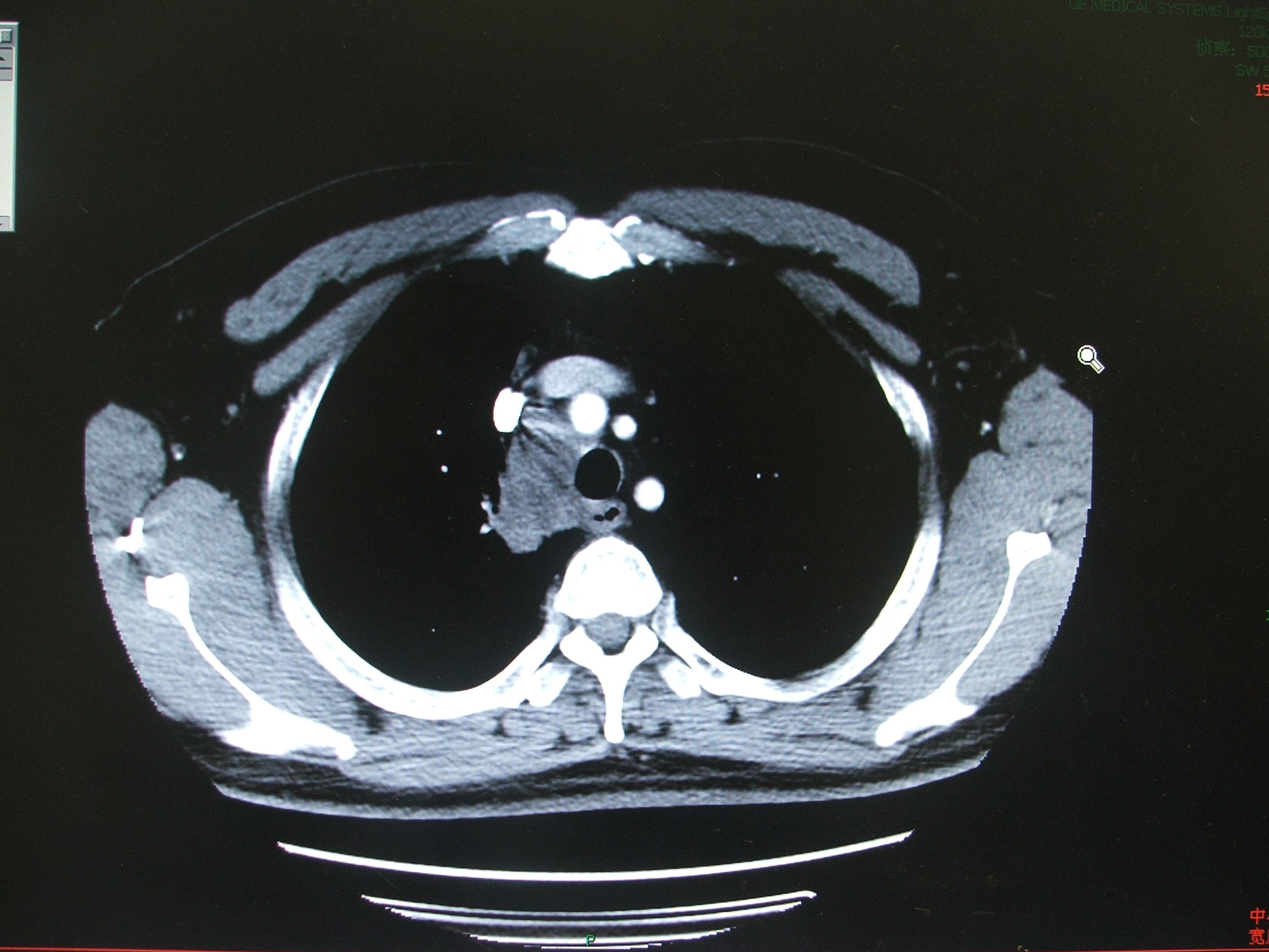 出院时胸片胸部ct:右侧上纵隔肿物,侵犯气管,与食管,右侧无名动脉,上