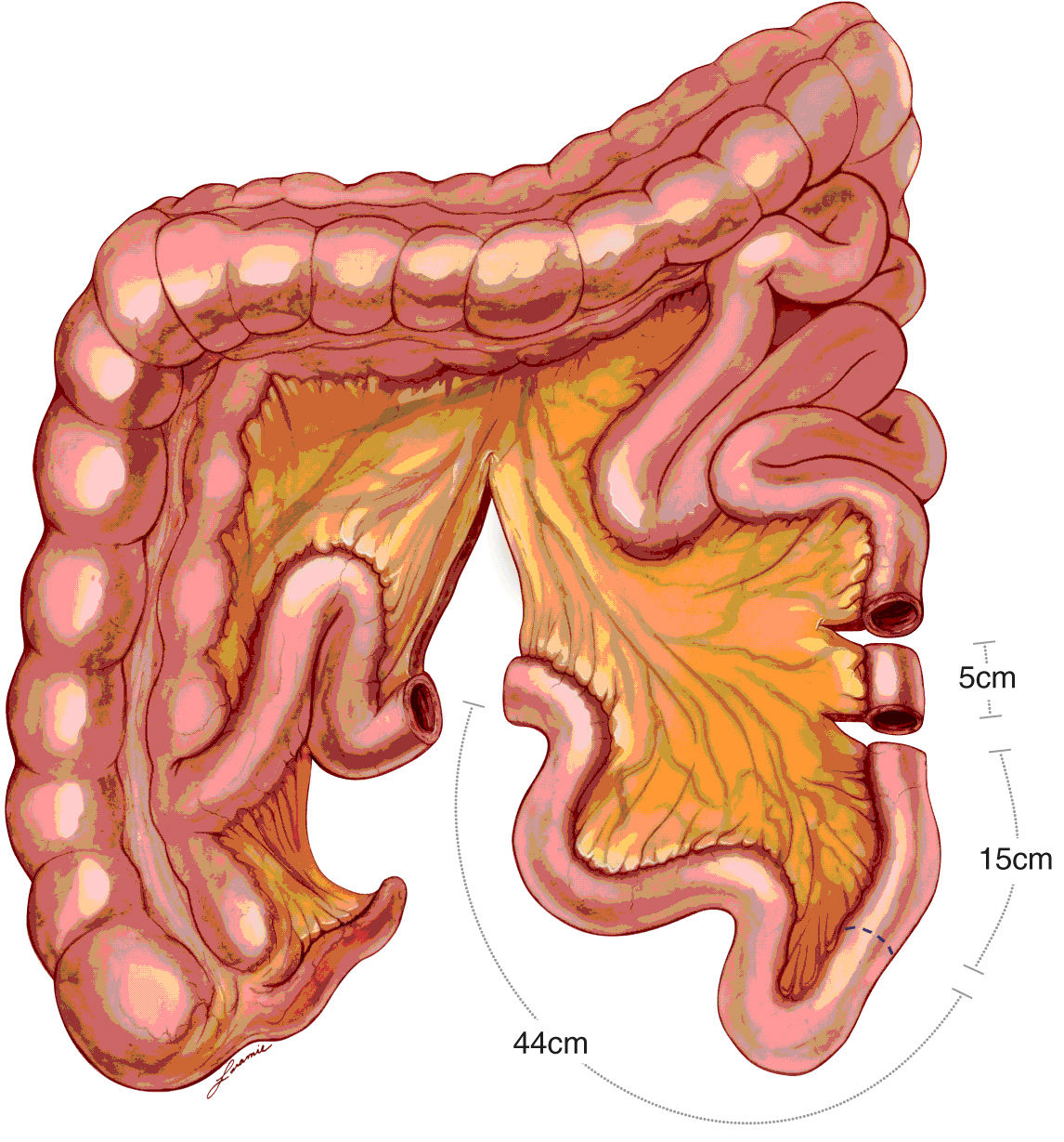 可控性尿流改道