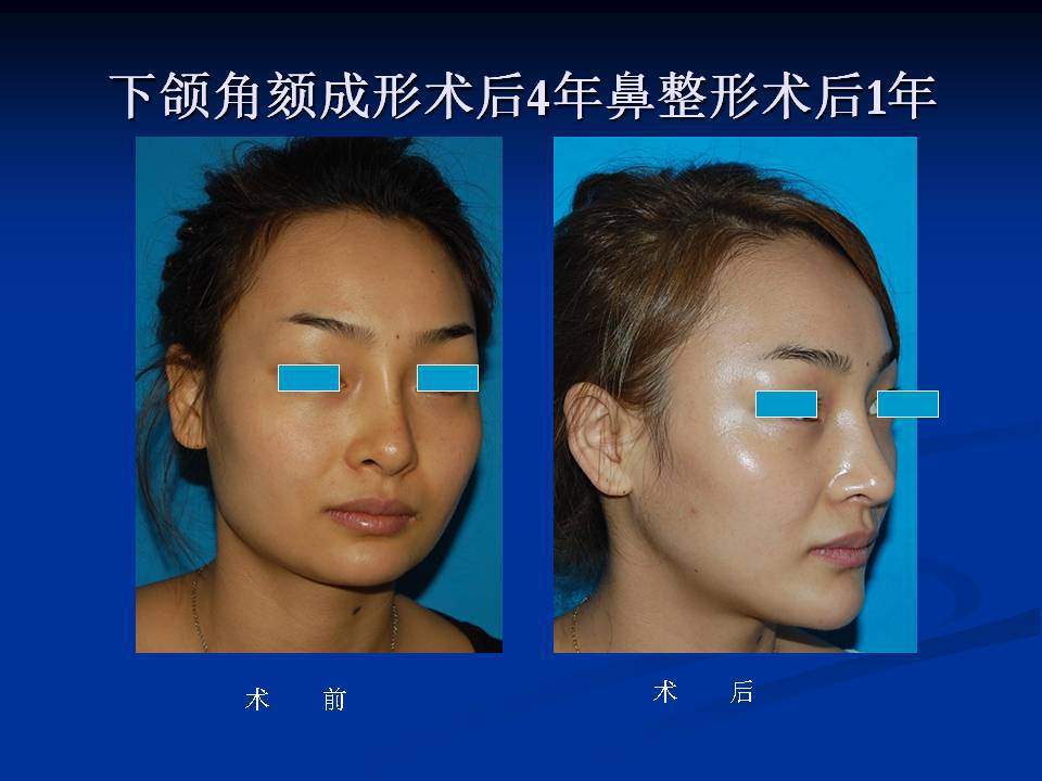 下颌角颏成形术后4年对比照片