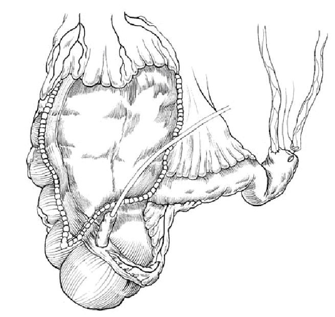 膀胱癌患者手术选择_膀胱癌_疾病介绍_介绍 - 好大夫在线